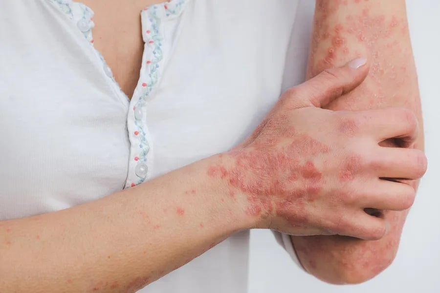 Psorijaza: Ozbiljna imunološka bolest koje zahvaća "više od kože"